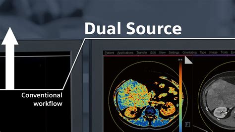 dszcvt|Principles and applications of dual source CT .